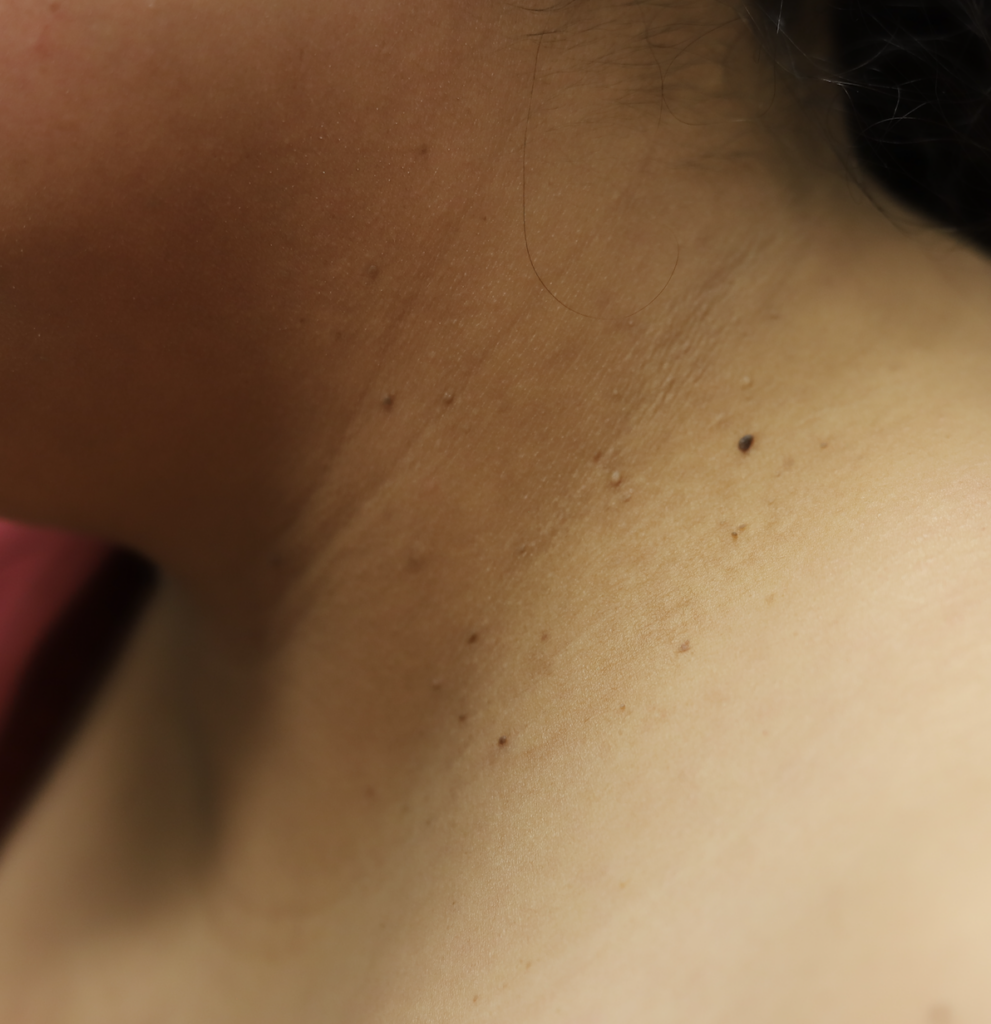 Acanthosis nigricans